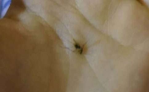 被蚊子咬肿了怎么消肿
